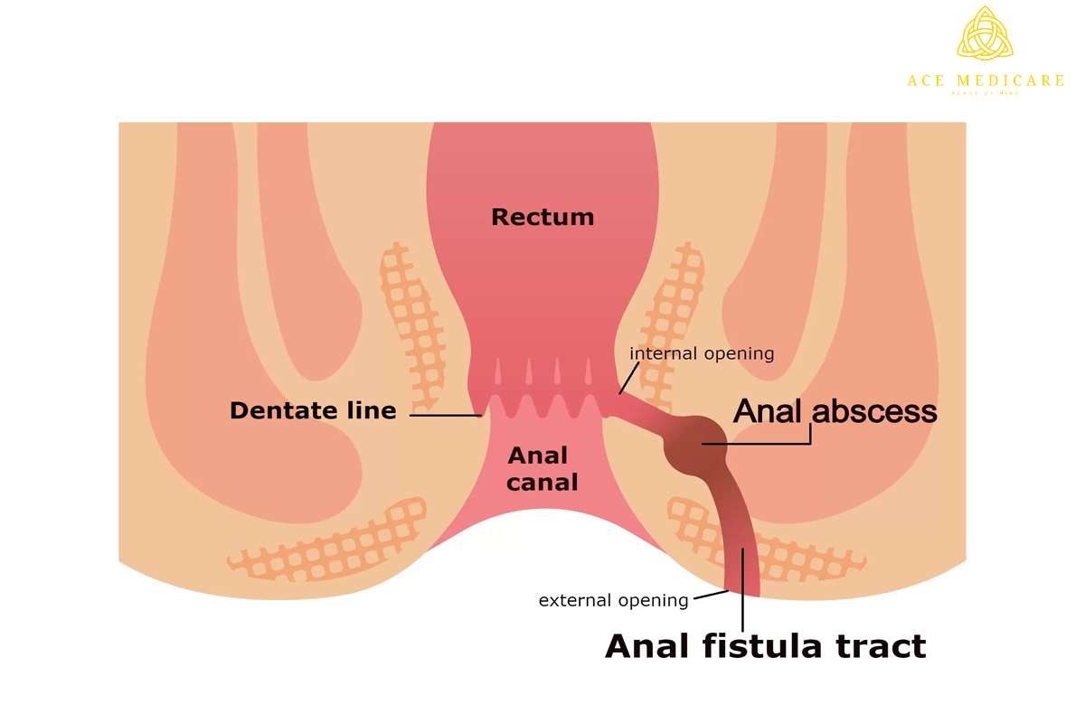 Exploring Surgical Interventions for Anal Fistula: A Comprehensive Guide